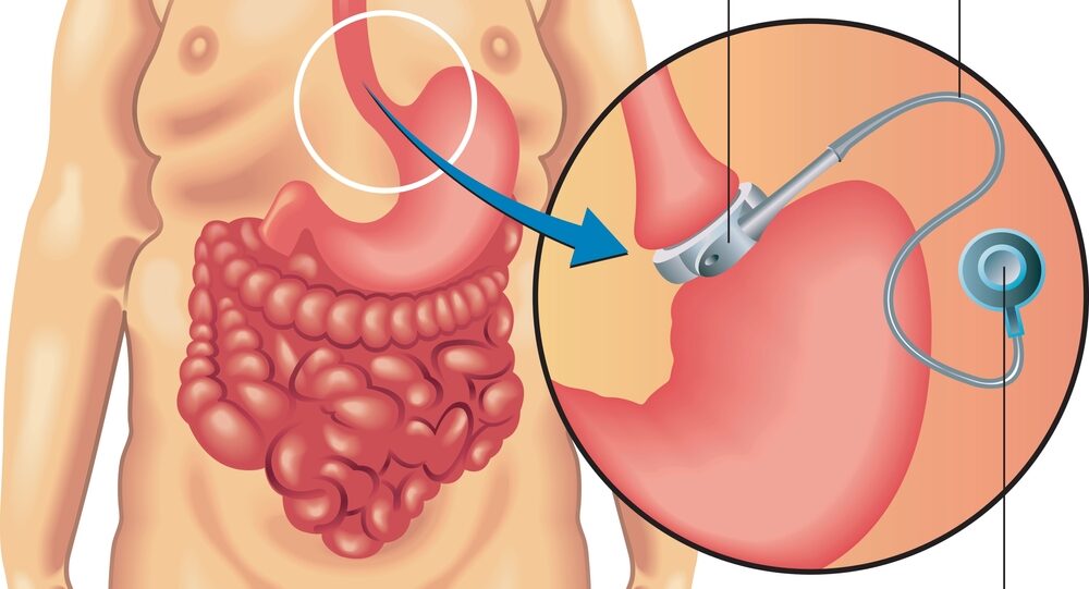 Medical,Illustration,Of,An,Adjustable,Gastric,Banding.