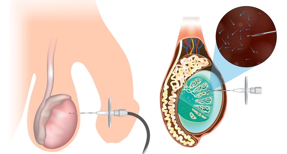 Percutaneous,Testicular,Biopsy,Or,Tesa.,Punction,In,The,Testicle.,Surgical