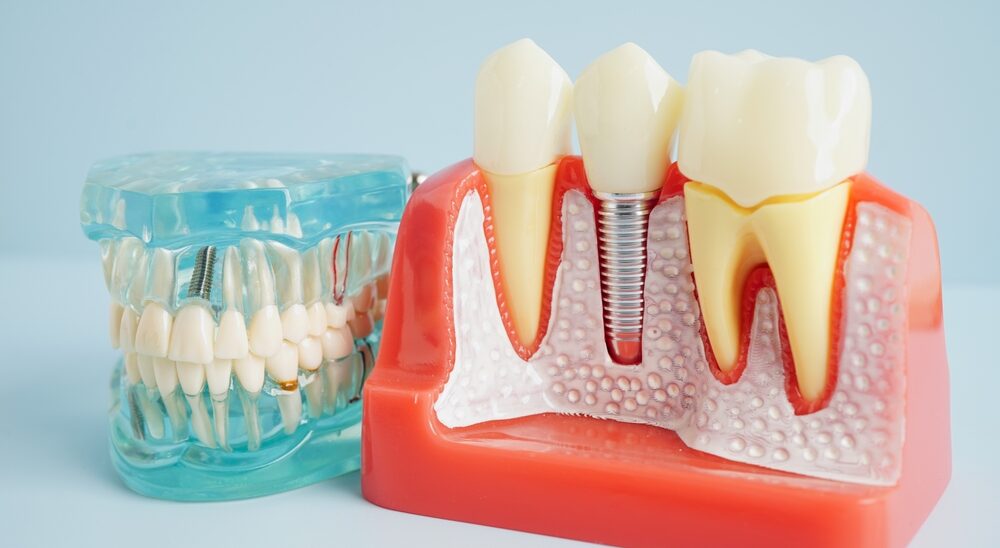 Dental,Implant,,Artificial,Tooth,Roots,Into,Jaw,,Root,Canal,Of