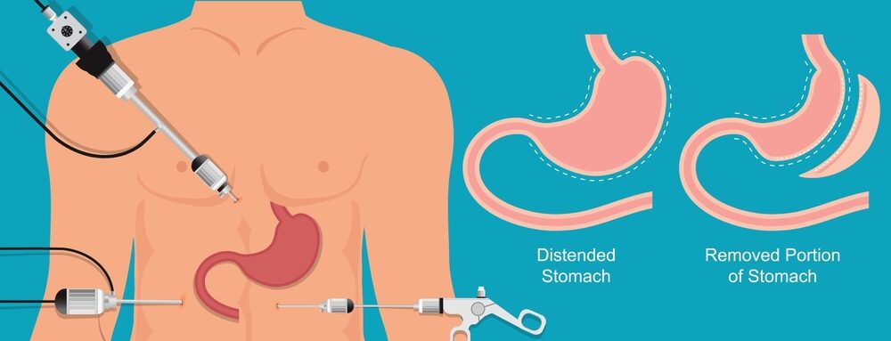 Bariatric,Surgery,Is,Done,When,Diet,And,Exercise,Haven't,Worked