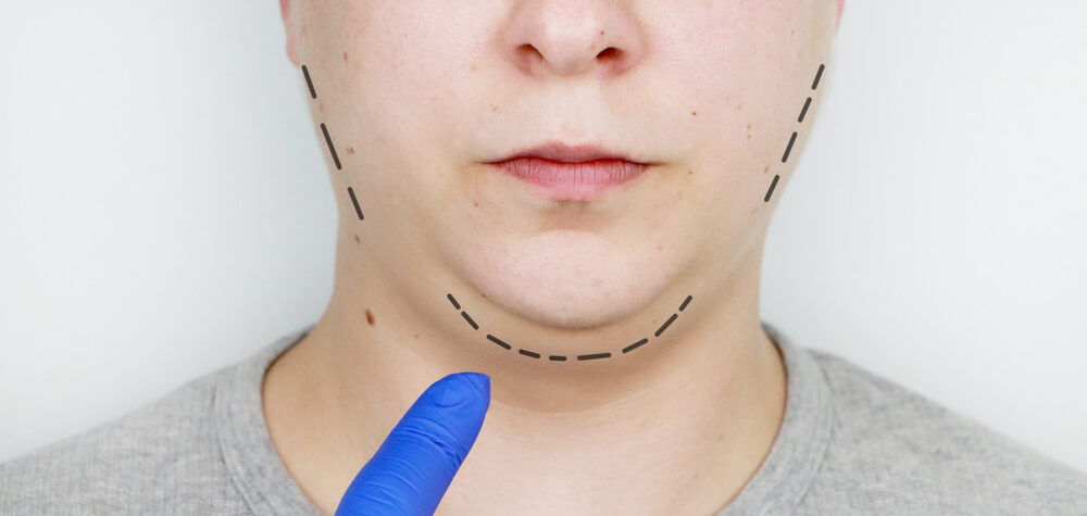 Chin lift - mentoplasty. A man at the reception at the plastic surgeon. Preparation for surgery. Get rid of a double chin