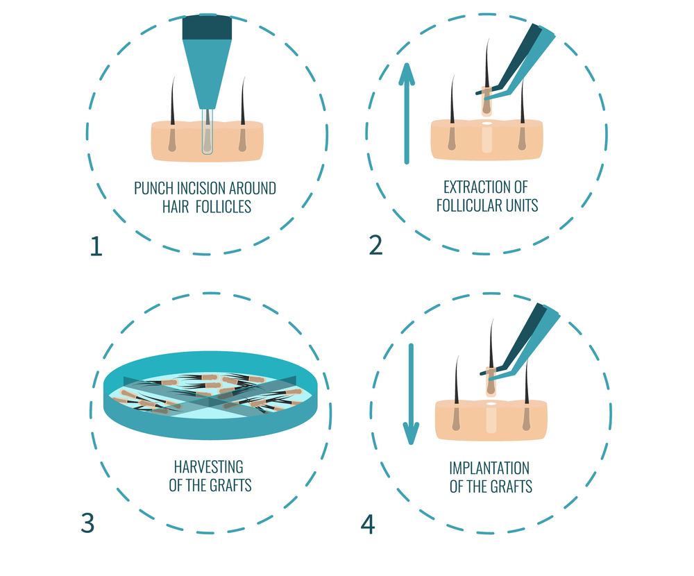 Les étapes clés de la FUE greffe capillaire en Tunisie avec Axess Medical, de la consultation initiale à l'implantation, pour des résultats naturels et durables.