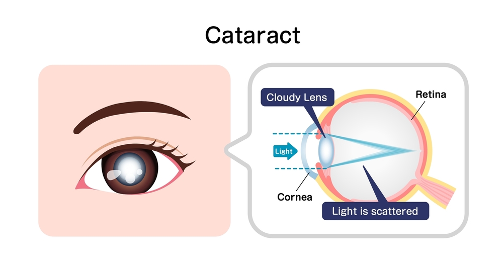 Comment se Déroule la Chirurgie de la Cataracte ?
