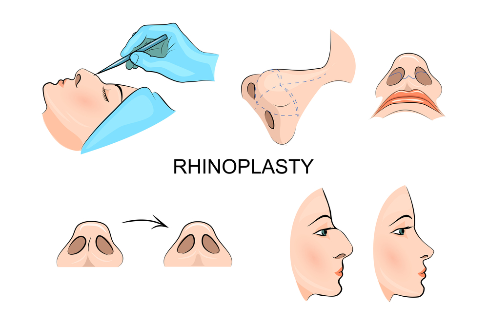 illustration de rhinoplastie. chirurgie esthétique. médecine esthétique. image 