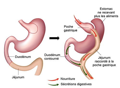 Comment se déroule l’intervention de Bypass Gastrique ?