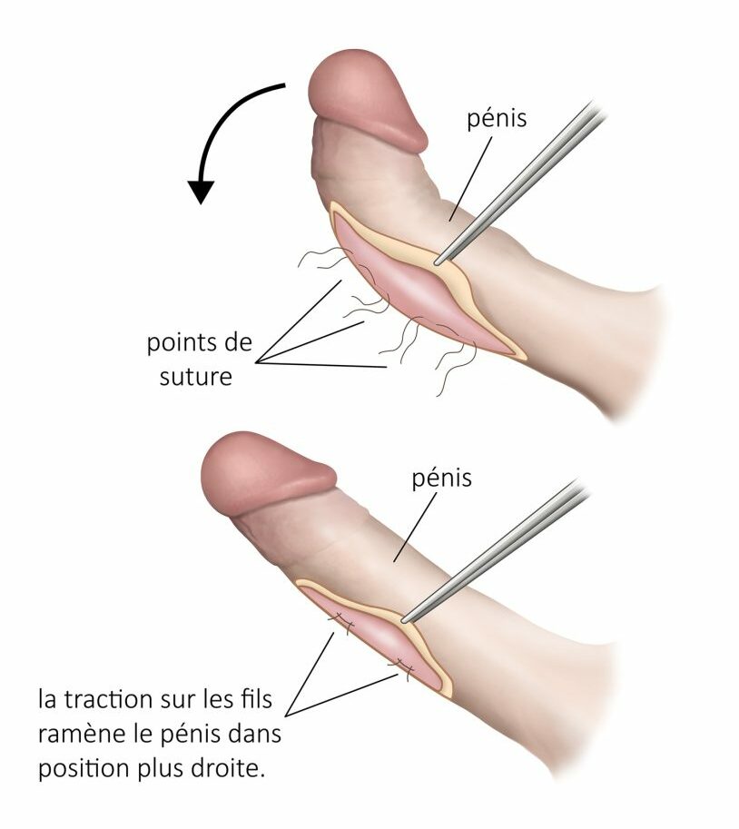 Étapes d’une Pénoplastie en Tunisie