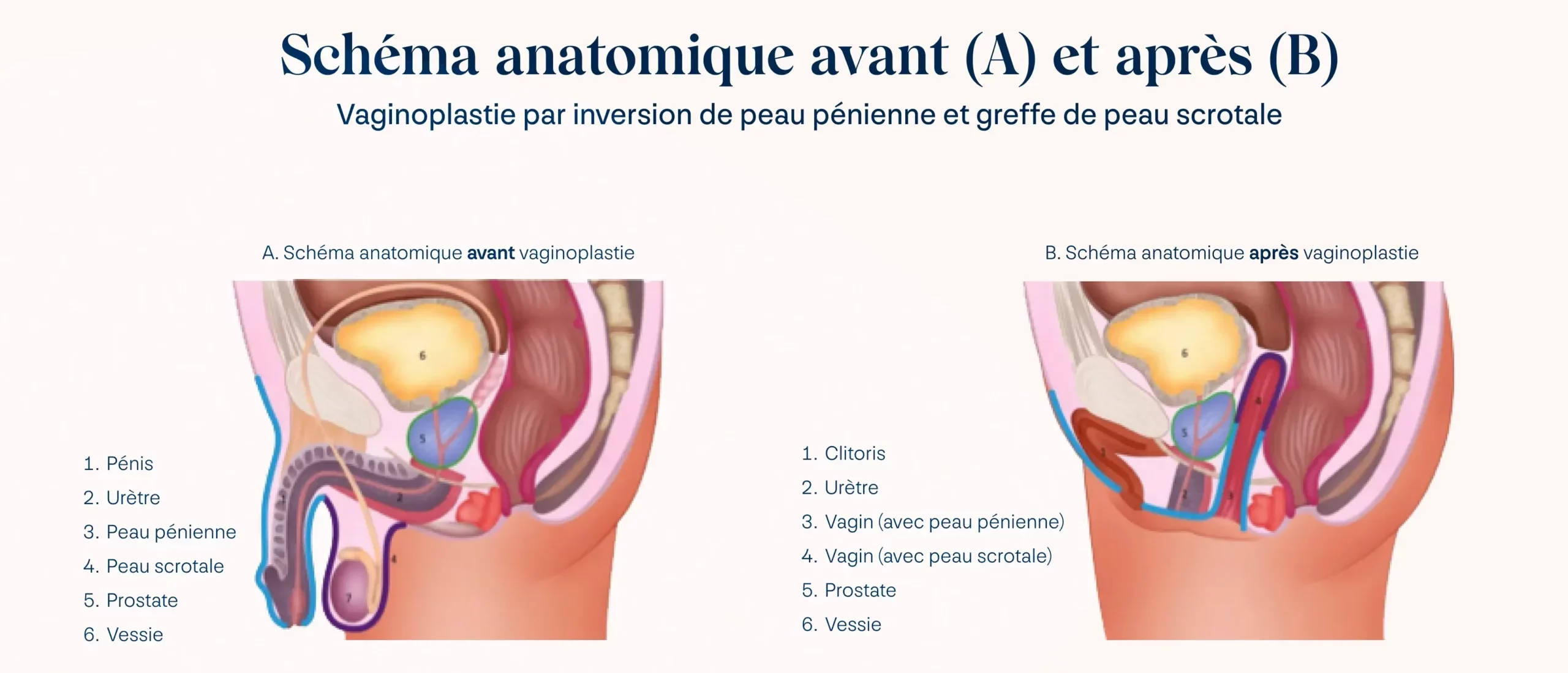 Vaginoplastie réalisée par Axess Medical en Tunisie, offrant des solutions personnalisées pour améliorer le confort et l'esthétique intime des femmes.