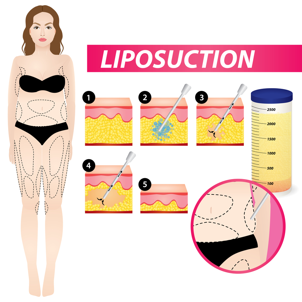 Liposuccion,,,Femme,Graisse,Chirurgie,Vecteur,Illustration