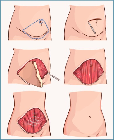 Processus d’Abdominoplastie chez Axess Medical