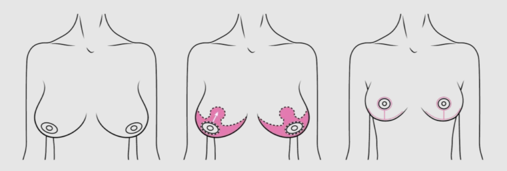 Chirurgie de réduction mammaire réalisée à Axess Medical en Tunisie, avec des résultats naturels et harmonieux.