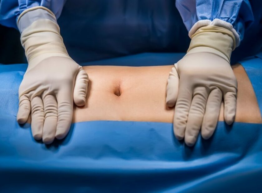 Abdomen,Prepare,For,Abdominal,Surgery,With,Sterile,Drape.surgeon,Or,Nurse